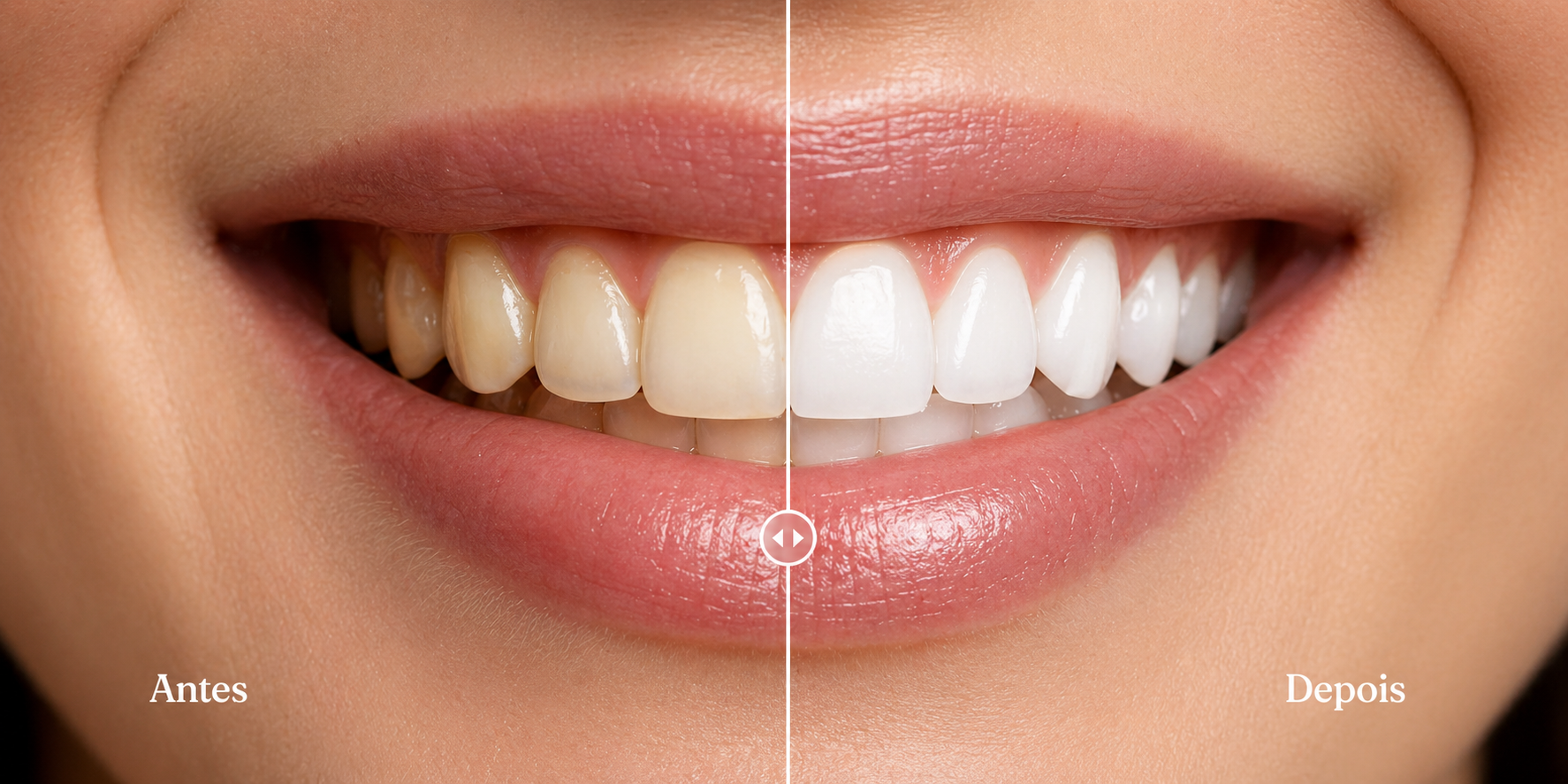 Comparativo antes e depois de clareamento dental